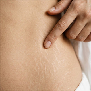 Smagliature - Eterea Cosmesi Naturale